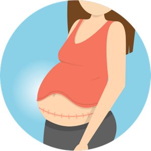 Incision healing and recovery after C-section delivery