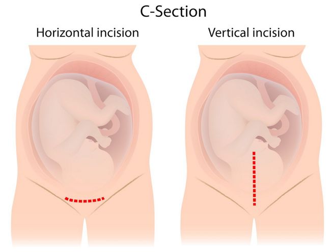 caesarean-wound-healing-1