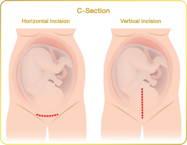 c-section-how-to