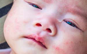 Food-Allergy-Children-Banner