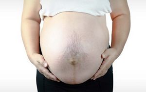 stretch-marks-banner