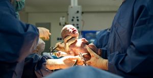 Hi-Q caesarean need to know